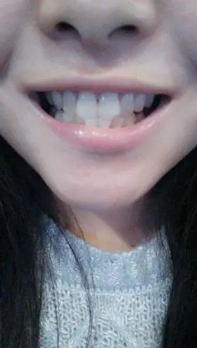 这是兔子牙吗,不会长成龅牙吧,这几天天天注意力