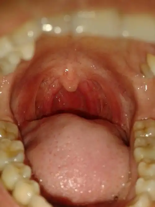 我从来都不抽烟,不喝酒,22岁,昨晚吃了个泡面,今天早上喉咙就又红又肿