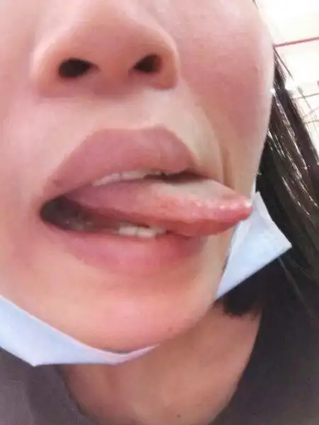 请问我的舌头是怎么回事呢?是毛状白斑吗?