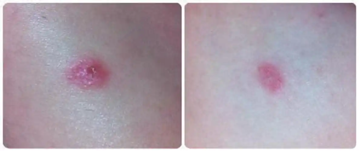 男性梅毒感染图片潜伏期