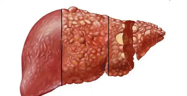 原发性肝癌的临床表现
