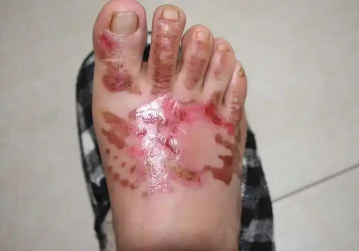 脚背被开水烫伤,面积较大,已12天,现已初步结痂,但烫伤面还是红色的