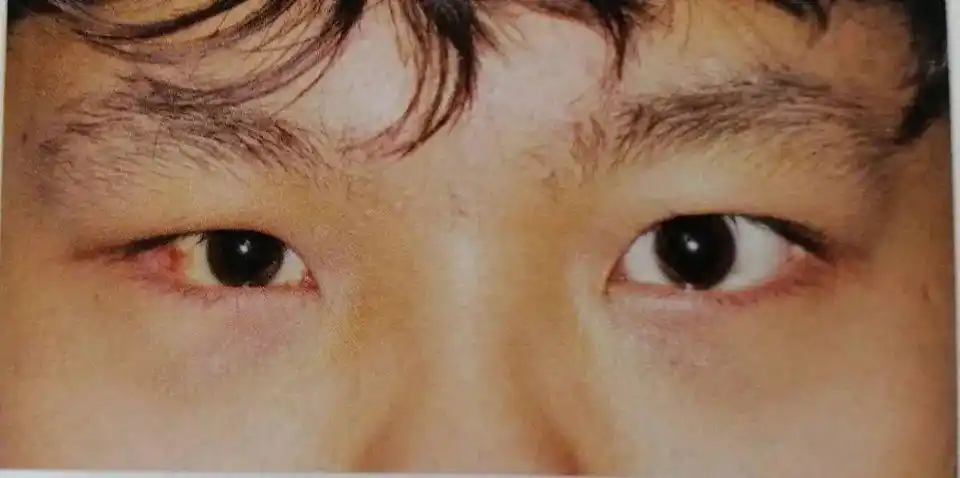 别怕,个性化的预成型钛网新技术打造"精准手术"_眼球