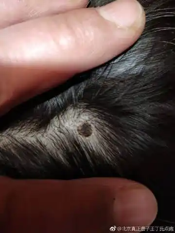 孩子的头发里面长了凸起的黑痦子.很硬.怕今后经常梳头摩擦引起癌变.