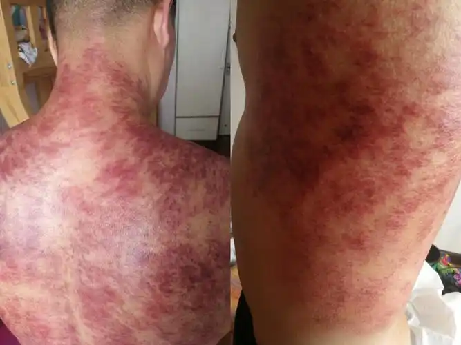 李氏虎符铜砭刮痧之春养肝