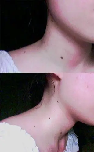 从【面相】上来说脖子上的三颗痣 肩膀一颗痣该不该祛?