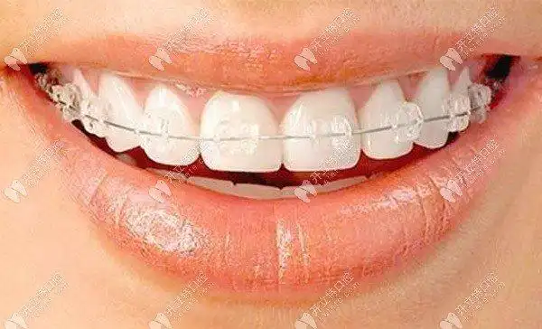 冰晶半隐形托槽矫正器