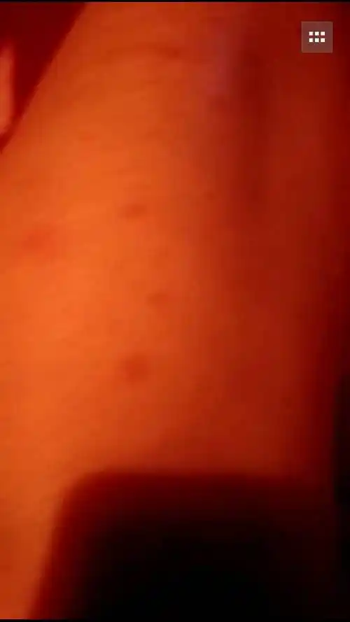 我妈皮肤病又犯了,十几年了,好了几年.