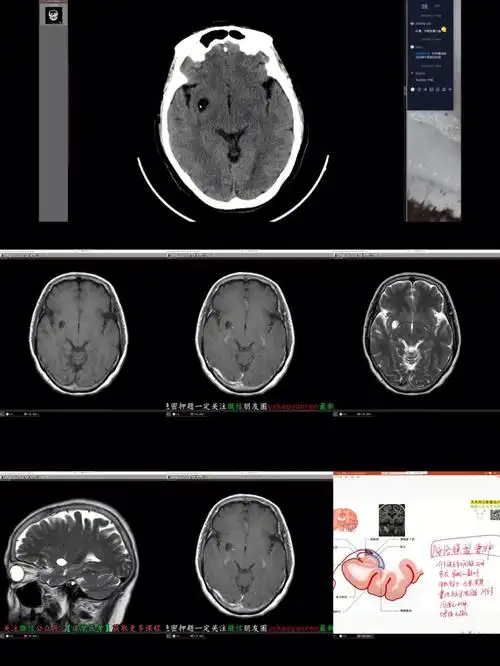 规培生活之脑膜瘤&脉络膜裂囊肿