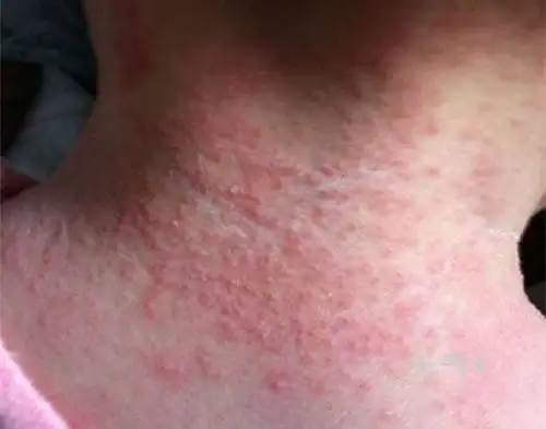 痱子症状图片 痱子和湿疹的区别