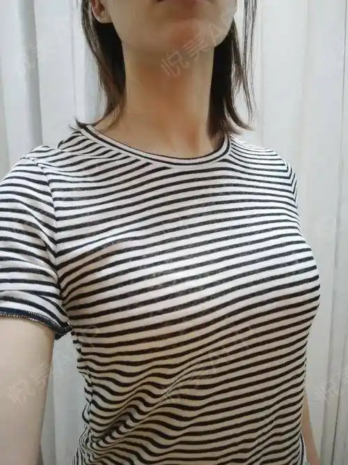 自体脂肪隆胸术后35天_形体填充术后35天_隆胸术后35天_自体脂肪术后