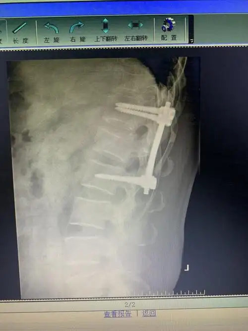 腰椎爆裂骨折并脊髓损伤 - 好大夫在线