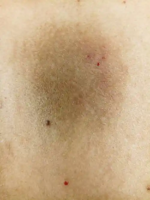 后背一片发黑有时痒什么病呢治疗情况使用过曲咪新乳膏