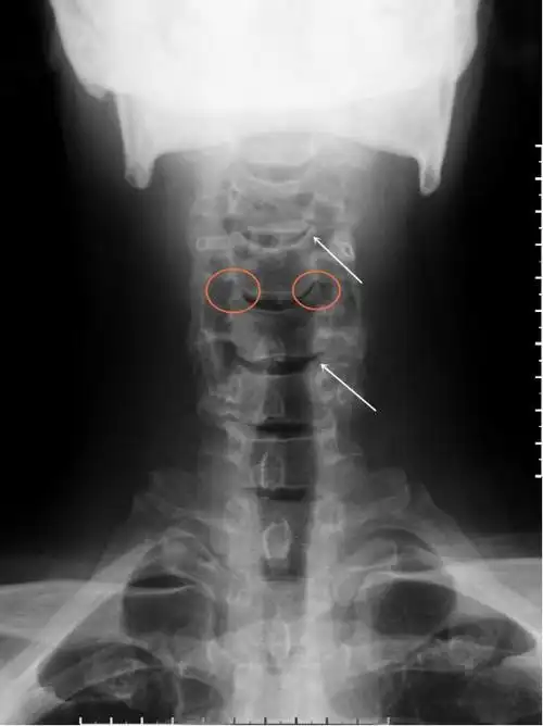 看两侧钩椎关节间隙是否相对对称?当急慢性损伤,椎体钩突常出