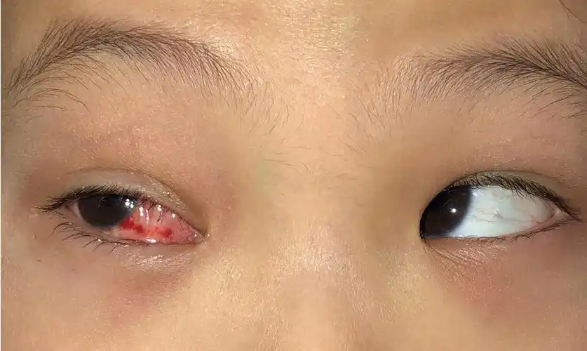 小儿斜视_小儿斜视治疗方式 - 好大夫在线