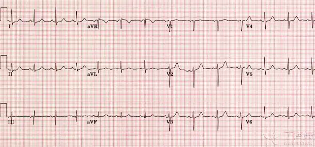 心电图学习系列之一:正常心电图的形成和一般判断机制