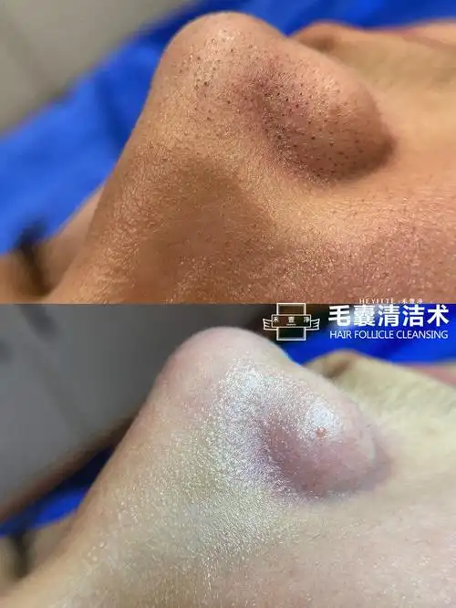 毛囊清洁术除了深层清洁之外,还有以下几大功效: 第一:市面上唯一一款