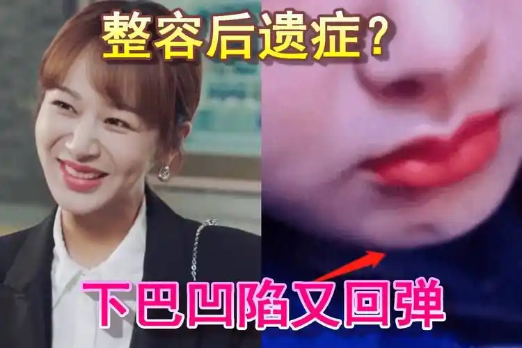 杨紫《余生》中下巴凹陷又回弹,笑起来脸部僵硬