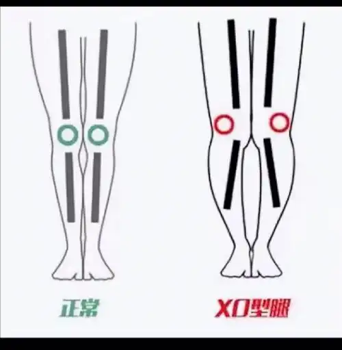 干货集锦关于xo型腿的矫正少走弯路