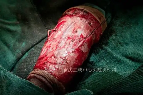 【效果评估】行阴茎背神经选择性切断术后,可以降低阴茎头的敏感性