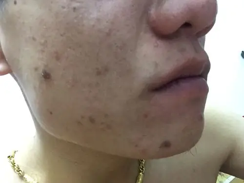 谁知道我下巴上和脸颊边上那块黑色得斑是什么!是痘痘消退以后有的!