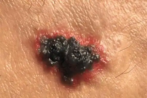 皮肤癌早期症状( 皮肤癌早期症状图片 初期 )