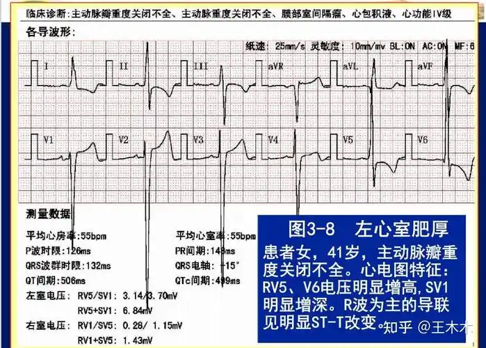 心电图心房肥大心室肥厚