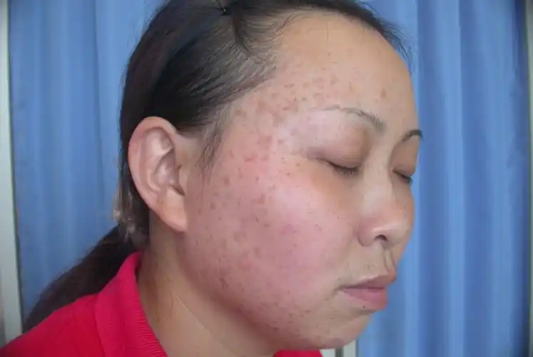 嘉义市扁平疣专家_嘉义市治疗扁平疣哪个专家好_嘉义市治疗扁平疣最好