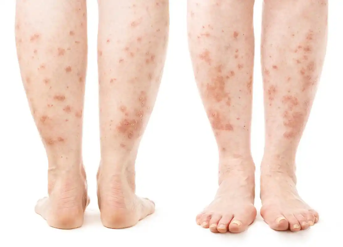 湿疹早期症状揭秘:如何辨识并及早防范皮肤问题? 湿疹是一种常见的皮