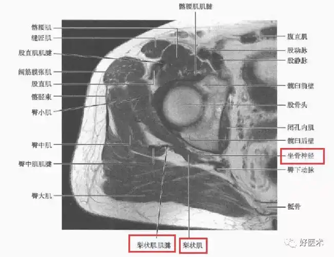 神经(sciatic nerve),sp:骶丛,stl:骶结节韧带,sg:上宨肌,oi:闭孔内肌