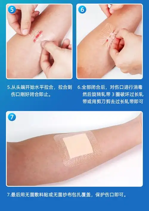 减张器拉链式创口贴医用皮肤疤痕减张贴儿童成人张力贴刨腹产术后减