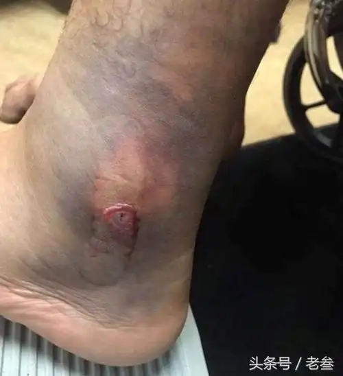 他是唯一一个被24.1毫米子弹击中脚腕还能走路的人
