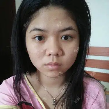 额头窄不饱满脸圆应该怎么办