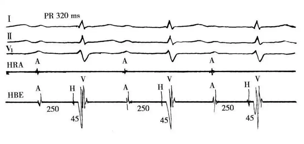 房室传导阻滞心电图学