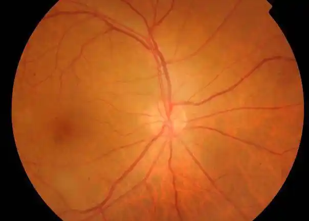 视网膜病变症状属于糖尿病视网膜病变得早,中期,在医学上称为"非增殖
