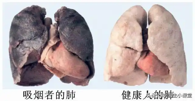 戒烟后黑了的肺还能白回来吗患癌几率能下降医生告诉你真相