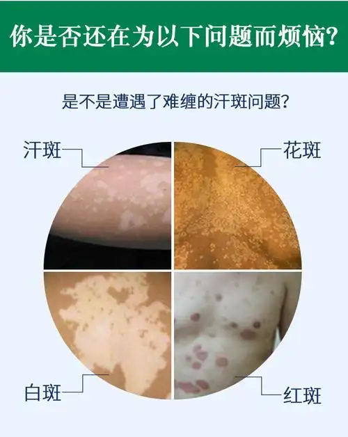 妙丹堂汗斑净 汗斑露 白斑花斑癣白癜风补骨脂止汗抑菌液