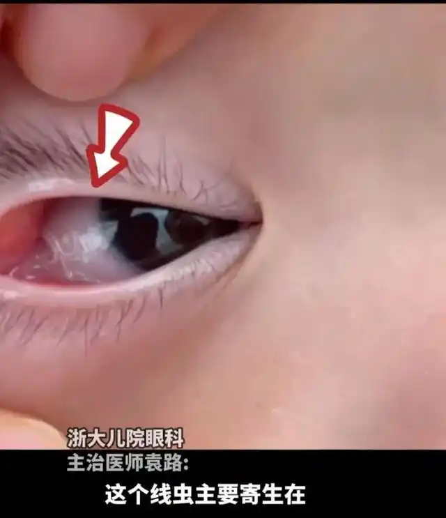 8个月大的孩子眼睛里取出寄生虫