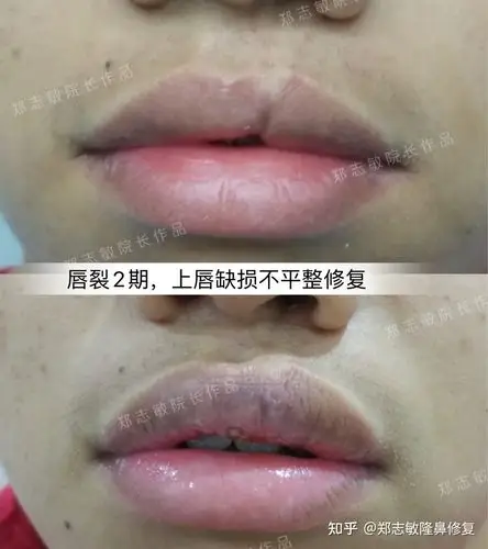 一个唇裂2期修复唇缘畸形的案例