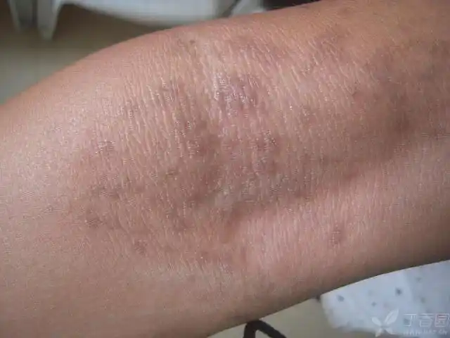 患者 男 一个月前出现皮疹,不痒不痛