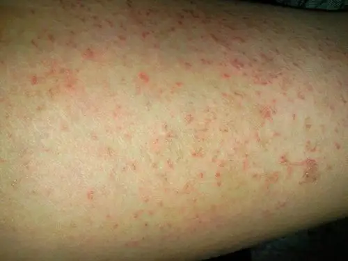 身体长了红斑,瘙痒,差不多一个月了,请问下是什么皮肤病!如何治疗_百