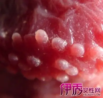 珍珠疹会好吗珍珠疹会痒