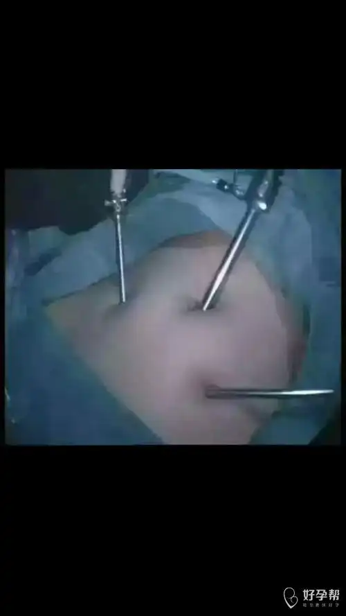 下面这幅图片是女人输卵管堵塞,做宫腹腔镜手术的图片!