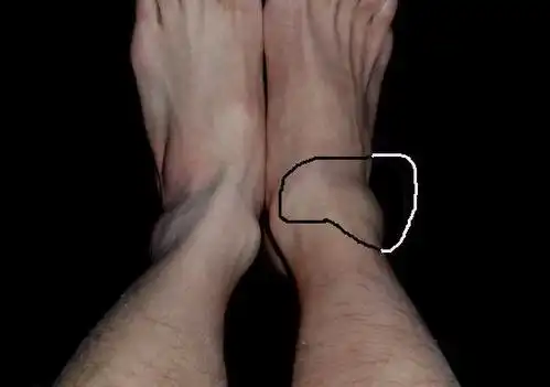 现在基本消肿可以缓慢行走, 但是脚踝外侧的骨头朝前端有硬块,按下去