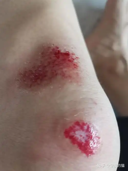 附上右腿留的疤和左腿摔伤的照片,左腿周围还是红肿状态,苦命的我请假