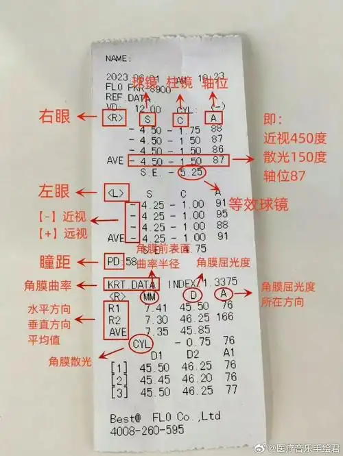例如下图的案例,右眼的数据就是:  近视450度,散光150度,轴位87  而