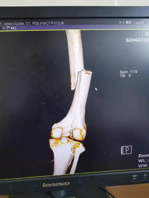 右侧股骨外髁骨折3.右侧股骨干骨折4.
