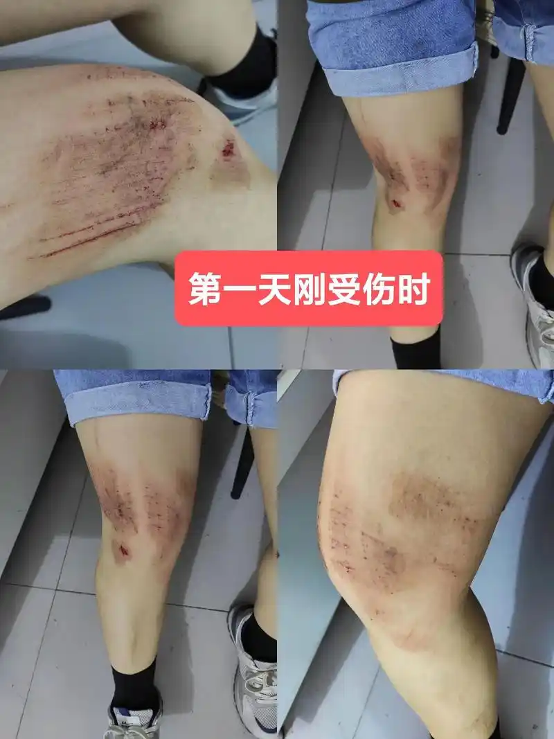 意外受伤.就是一个浅表擦伤而已,……第16天伤口愈合,连伤疤 - 抖音