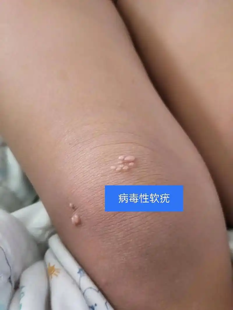 软疣提取完成病毒性软疣自身传播力强