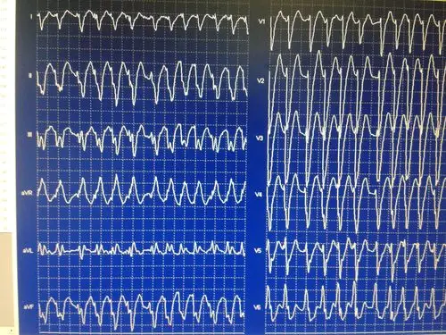 这幅图是房颤伴差传还是伴预激还是室速发动态心电图继续讨论